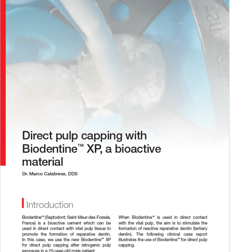 direct-pulp-capping-with-biodentine-xp-a-bioactive-material
