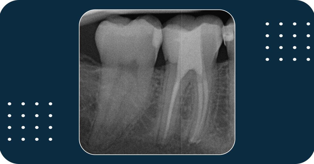 Obturation protocol for general practice - Dr. Sascha Herbst