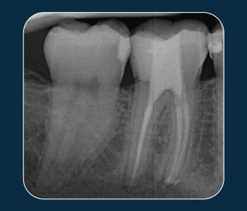 Obturation protocol for general practice - Dr. Sascha Herbst