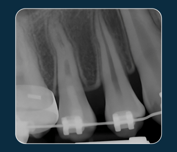 PULPAL REGENERATION OF TWO NECROTIC PREMOLARS WITH DENS EVAGINATUS_A CASE SERIES